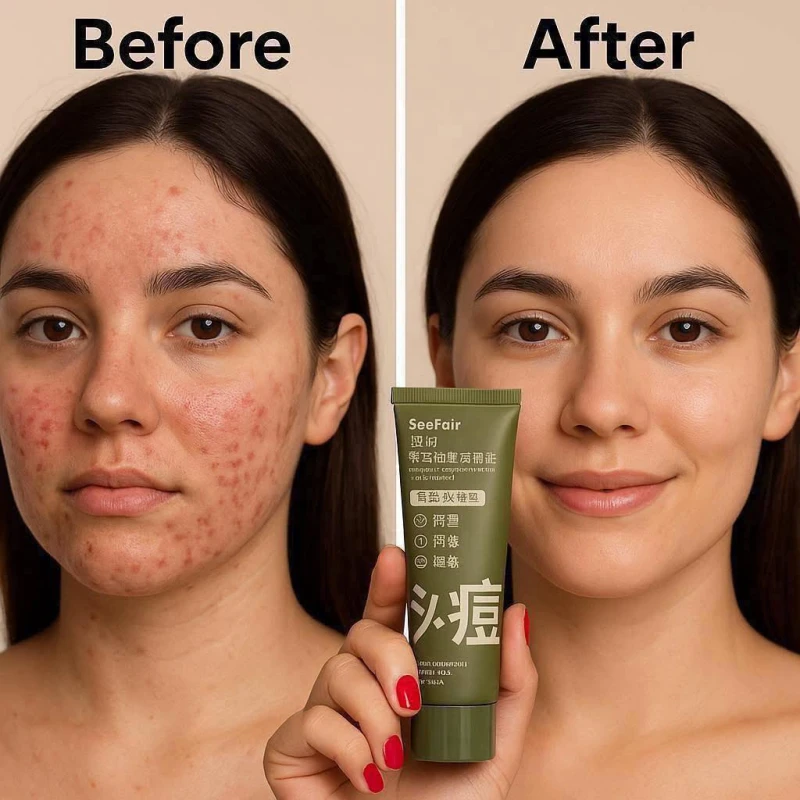 Herbal Acne Control Facewash